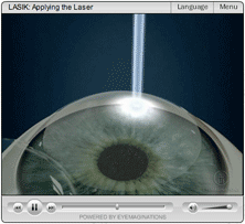 All LASER LASIK